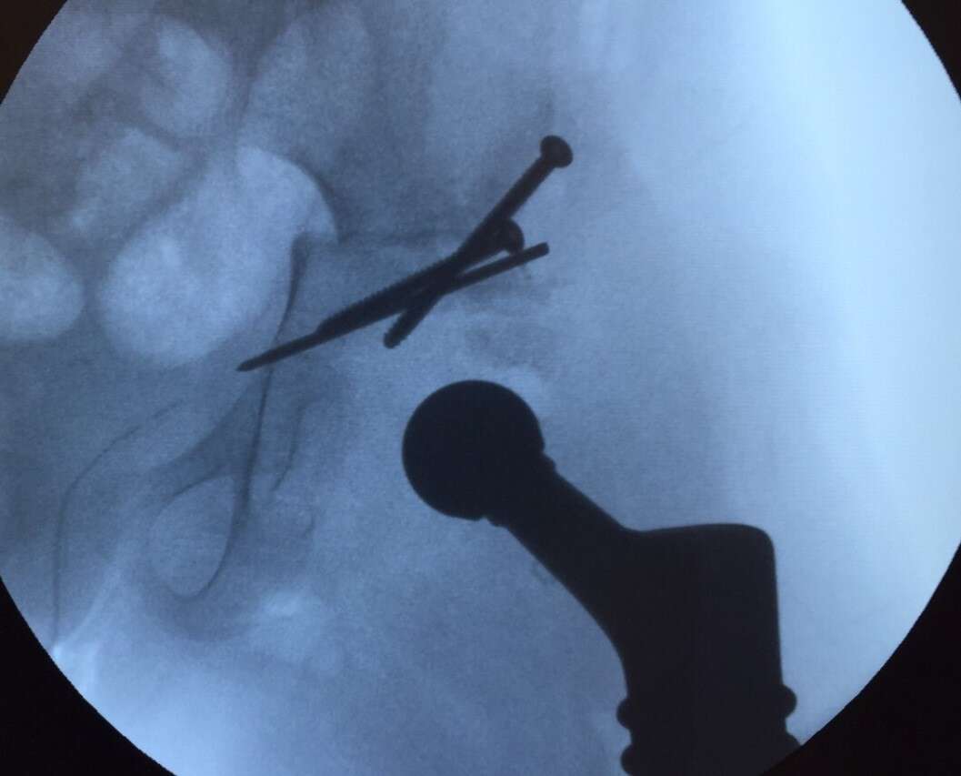 Surgical flouroscopy with re-positioned acetabulum 